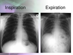 Chest Radiology Techniques Overview | PDF | Thorax | Lung