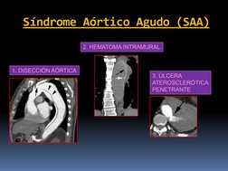 1. DISECCIÓN AÓRTICA 
