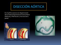 En el 90% se asocia con degeneración 
de la media (fragmentación de las fibras 
elásticas), inflamación y necrosis de la 
par