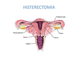 HISTERECTOMIA 
