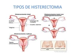 TIPOS DE HISTERECTOMIA 
