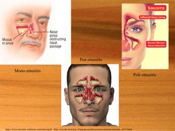 http://www.sinusitis-solutions.com/intro.html ; http://escuela.med.puc.cl/paginas/publicaciones/otorrino/otorrino_a015.html
P