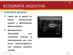 10
Intestino grueso

capas de la pared se 
hayan 
íntimamente 
unidas y difícilmente 
diferenciables.

Normalmente 
disten