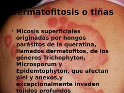 Dermatofitosis o tiñas
• Micosis superficiales 
originadas por hongos 
parásitos de la queratina, 
llamados dermatofitos, de