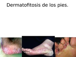 Dermatofitosis de los pies.
