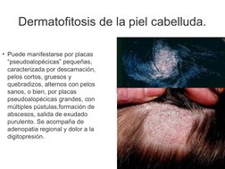 Dermatofitosis de la piel cabelluda.
• Puede manifestarse por placas 
“pseudoalopécicas” pequeñas, 
caracterizada por descama