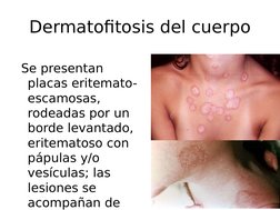 Dermatofitosis del cuerpo
 Se presentan 
placas eritemato-
escamosas, 
rodeadas por un 
borde levantado, 
eritematoso con 
pá