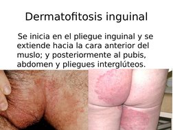 Dermatofitosis inguinal
   Se inicia en el pliegue inguinal y se 
extiende hacia la cara anterior del 
muslo; y posteriorment