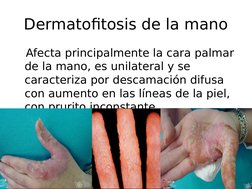 Dermatofitosis de la mano
   Afecta principalmente la cara palmar 
de la mano, es unilateral y se 
caracteriza por descamació