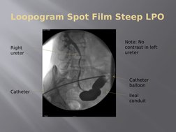 Loopogram Spot Film Steep LPO
Right 
ureter
Catheter
Catheter 
balloon
Ileal 
conduit
Note: No 
contrast in left 
ureter
