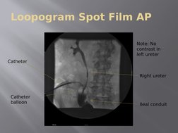 Loopogram Spot Film AP
Catheter
Catheter 
balloon
Ileal conduit
Right ureter
Note: No 
contrast in 
left ureter
