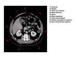 1) Vesicula 
2) Higado 
3) Vena cava inferior 
4) Riñon derecho 
5) Aorta 
6) Riñon izquierdo 
7) Colon descendente 
8) Arter