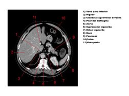 1) Vena cava inferior 
2) Higado 
3) Glandula suprarrenal derecha 
4) Pilar del diafragma 
5) Aorta  
6) Suprarrenal izquierd