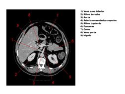 1) Vena cava inferior 
2) Riñon derecho 
3) Aorta 
4) Arteria mesenterica superior 
5) Riñon izquierdo 
6) Pancreas 
7) Colon