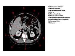 1) Vena cava inferior 
2) Riñon derecho 
3) Arteria renal derecha 
4) Aorta 
5) Riñon izquierdo 
6) Colon descendente 
7) Art