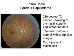 Frisen Scale for Grading Papilledema | PDF | Home & Garden | Wellness