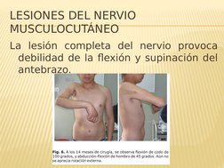 LESIONES DEL NERVIO 
MUSCULOCUTÁNEO
La lesión completa del nervio provoca 
debilidad de la flexión y supinación del 
antebraz