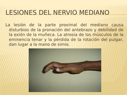 LESIONES DEL NERVIO MEDIANO 
La lesión de la parte proximal del mediano causa 
disturbios de la pronación del antebrazo y deb