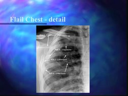Flail Chest - detail

