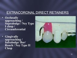 EXTRACORONAL DIRECT RETAINERS
• Occlusally 
approaching / 
Suprabulge / Ney Type 
I clasp / 
Circumferential 
     
• Gingiva