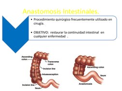 Anastomosis Intestinales. 
• Procedimiento quirúrgico frecuentemente utilizado en 
cirugía. 
 
• OBJETIVO:  restaurar la cont