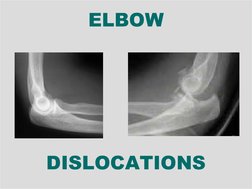  
 
ELBOW
DISLOCATIONS
