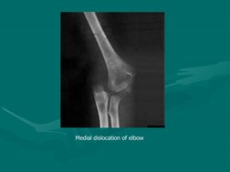 
 
                Medial dislocation of elbow
