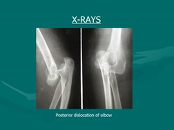  
 
                     X-RAYS
                Posterior dislocation of elbow
