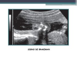 Signos radiográficos de óbito fetal | PDF