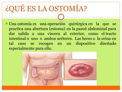 ¿QUÉ ES LA OSTOMÍA?
Una ostomía es una operación quirúrgica en la que se 
practica una abertura (estoma) en la pared abdomin