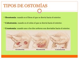 TIPOS DE OSTOMÍAS
Ileostomía: cuando es el íleon el que se desvía hacia el exterior.
Colostomía: cuando es el colon el que