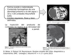-
Forma ovoide o redondeada
-
Contenido homogéneo de una 
densidad próxima a la del agua (–
10 a +20 unidades Hounsfield 
[UH