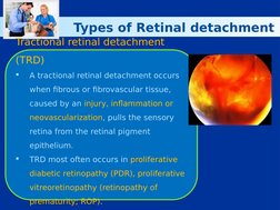 Overview of Retinal Detachment Types | PDF | Ophthalmology | Medical ...
