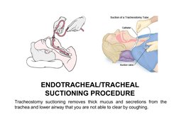 Tracheostomy Suctioning Procedure Steps | PDF | Clinical Medicine ...