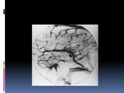 Carotid Cavernous Fistula Guide | PDF | Angiography | Angiology