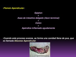 •Flemón Apendicular:
Epiplon
+
Asas de intestino delgado (ileon terminal)
+
Colón
+
Apéndice inflamado agudamente
•Cuando est