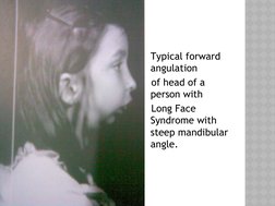 Long Face Syndrome Ppt
