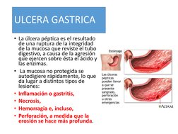 ULCERA GASTRICA
• La úlcera péptica es el resultado 
de una ruptura de la integridad 
de la mucosa que reviste el tubo 
diges