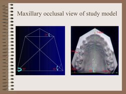 Maxillary occlusal view of study model
