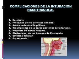 COMPLICACIONES DE LA INTUBACIÓN 
NASOTRAQUEAL
1. Epistaxis
2. Fracturas de los cornetes nasales.
3. Arrancamientos de pólipos