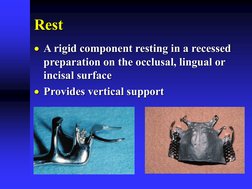 Resting Part Design Rests and Rest Seats in RPDs | PDF | Home & Garden