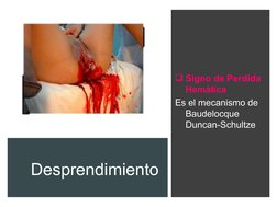 Desprendimiento
Signo de Perdida 
Hemática
Es el mecanismo de 
Baudelocque 
Duncan-Schultze

