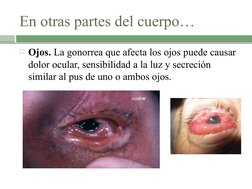 En otras partes del cuerpo…
Ojos. La gonorrea que afecta los ojos puede causar 
dolor ocular, sensibilidad a la luz y secrec