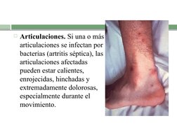 Articulaciones. Si una o más 
articulaciones se infectan por 
bacterias (artritis séptica), las 
articulaciones afectadas 
p