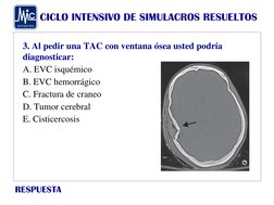 CICLO INTENSIVO DE SIMULACROS RESUELTOS
RESPUESTA
3. Al pedir una TAC con ventana ósea usted podría 
diagnosticar:
A. EVC isq