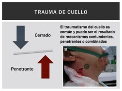 Cerrado 
Penetrante 
TRAUMA DE CUELLO
El traumatismo del cuello es 
común y puede ser el resultado 
de mecanismos contundente