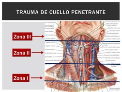 TRAUMA DE CUELLO PENETRANTE
Zona I
Zona I
Zona II
Zona II
Zona III
Zona III
