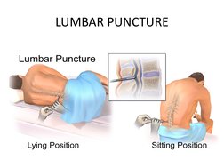 LUMBAR PUNCTURE
