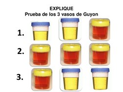 EXPLIQUE 
Prueba de los 3 vasos de Guyon 
1. 
 
2. 
 
 
 
 
 
 
 
3. 
