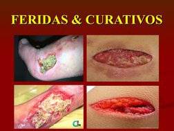 FERIDAS & CURATIVOS
FERIDAS & CURATIVOS
              
              
